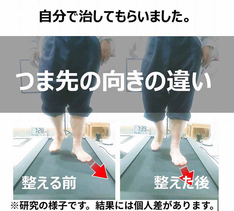 足底腱膜炎の原因になるトゥーアウト、自分で治す方法を動画で紹介