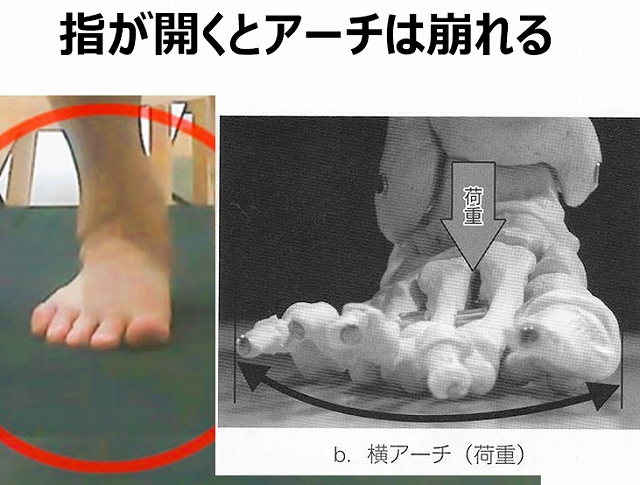 足指が横へ広がることで足部アーチの結束が弱まり、横アーチが低下しやすくなる仕組みを説明した図。