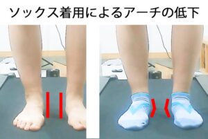 素足と一般的な靴下を履いたときのアーチの低下を比較した様子です。一般的な靴下を着用したとき、足のアーチが下がっている様子の画像。