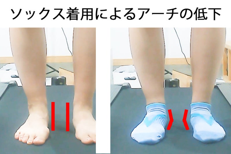 同じ人の素足と靴下着用時を比較し、靴下を履いたときに足部アーチが低くなった様子を示した画像