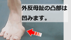 外反母趾