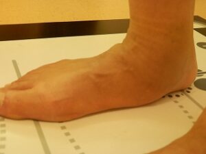 足のアーチが崩れる原因は何ですか? 後脛骨筋不全