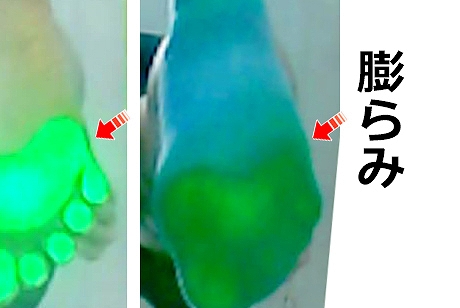 その結果、
MP関節の収縮(締め付け)力が不十分となり、
足部外側縦アーチおよび水平アーチの形成が妨げられていることが明らかである。