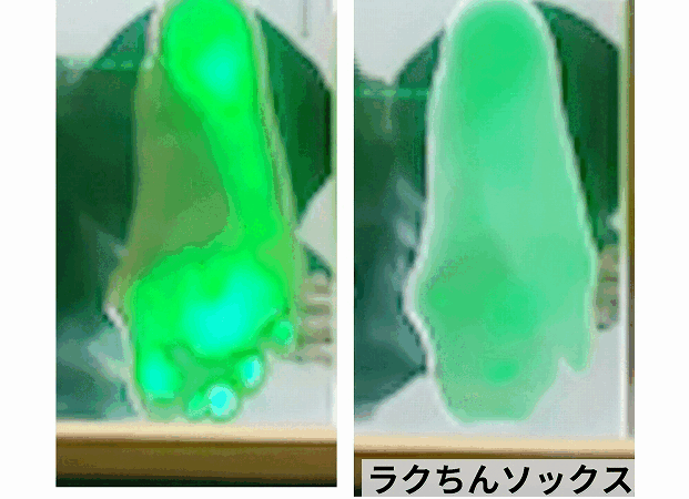 外反母趾の凸部の変位