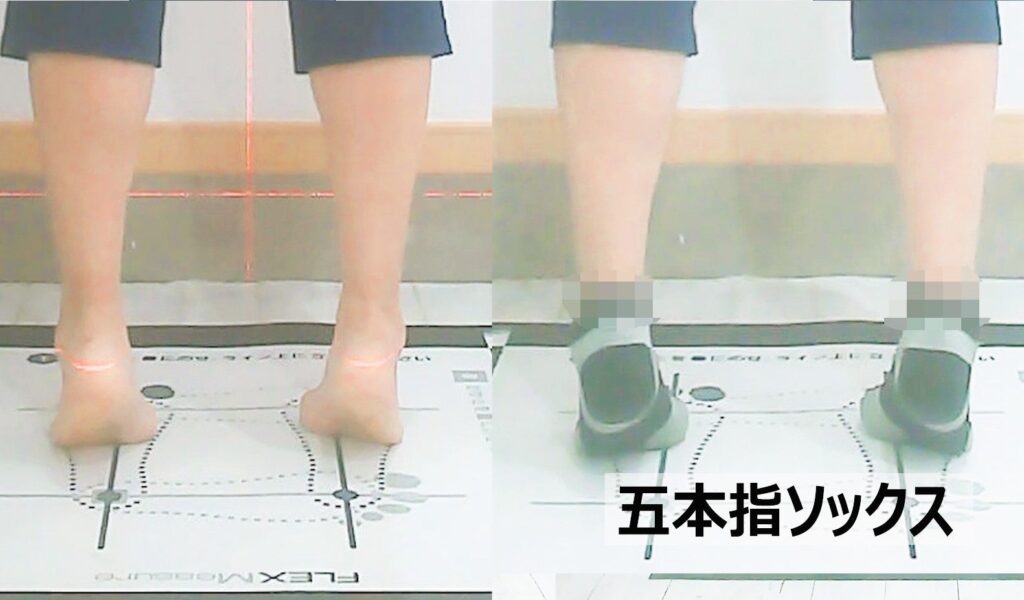 同一被験者のつま先立ち比較。素足では踵軸が直立するが、五本指ソックス装着時は足底剛性化の失敗により踵が外側へ逃げて挙上する。靴下の構造が荷重時の自然な運動連鎖を阻害し、膝や足首の関節に異常な捻れストレスを日常的に蓄積させるリスクを説明する画像。