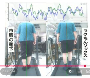 80代女性_重度の外反母趾と変形性膝関節症_歩行の比較 高齢SY歩行変形性外反母趾