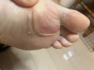 フルマラソン直後に母指球周辺へできた足裏のマメを確認している写真