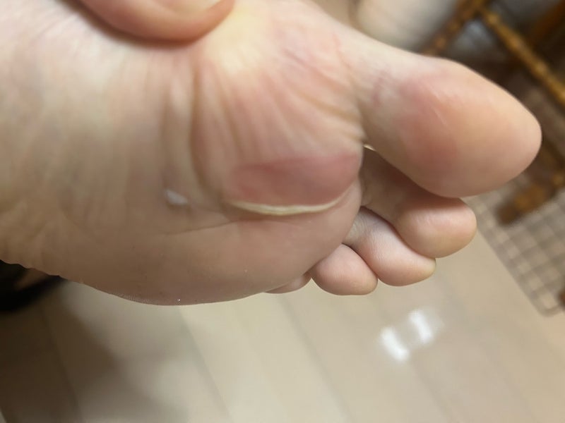 ランニング中に足裏へできたマメと靴擦れについて、発生した場所や皮膚の状態から原因の違いを確認するために撮影した足の画像