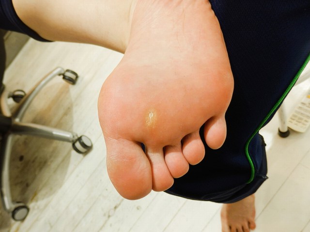 足裏にできるタコや魚の目の原因を説明する画像