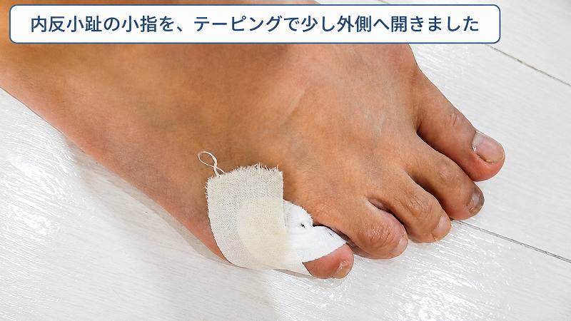 内反小趾の小指を外側へ開いた位置でテーピング固定した状態