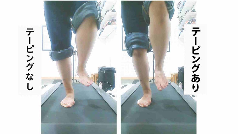 内反小趾の小指をテーピングで外側へ開く前後の片足立ちを比較した画像