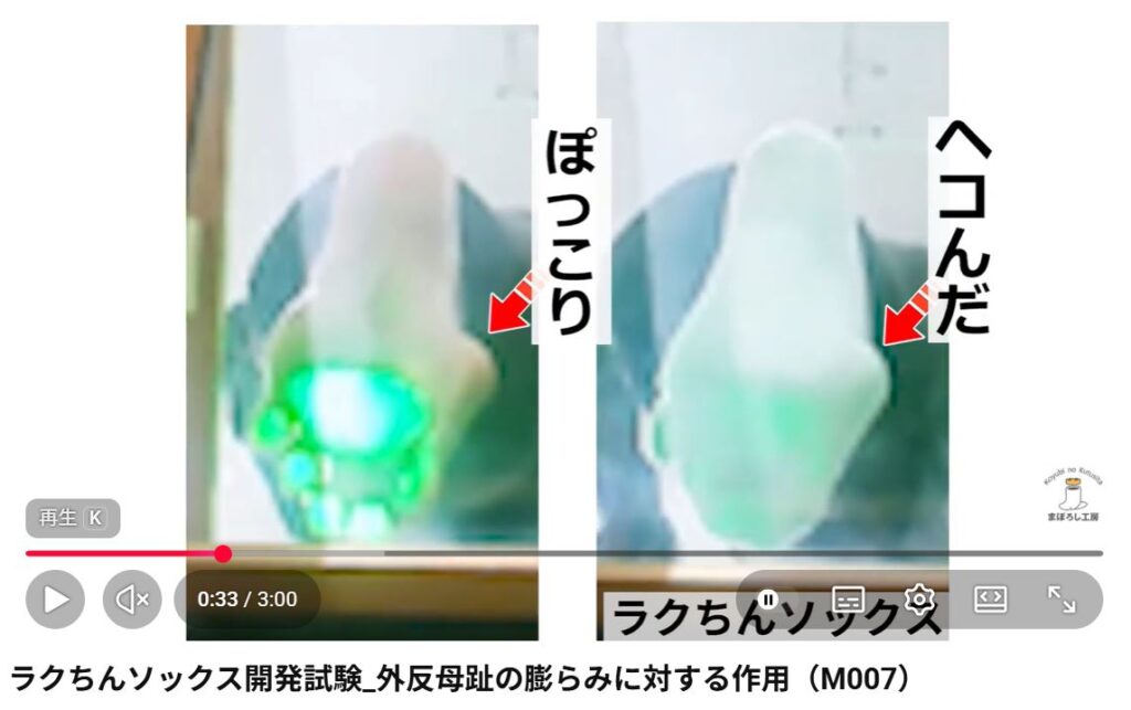 外反母趾のポッコリが凹む様子。ラクちんソックスを使用