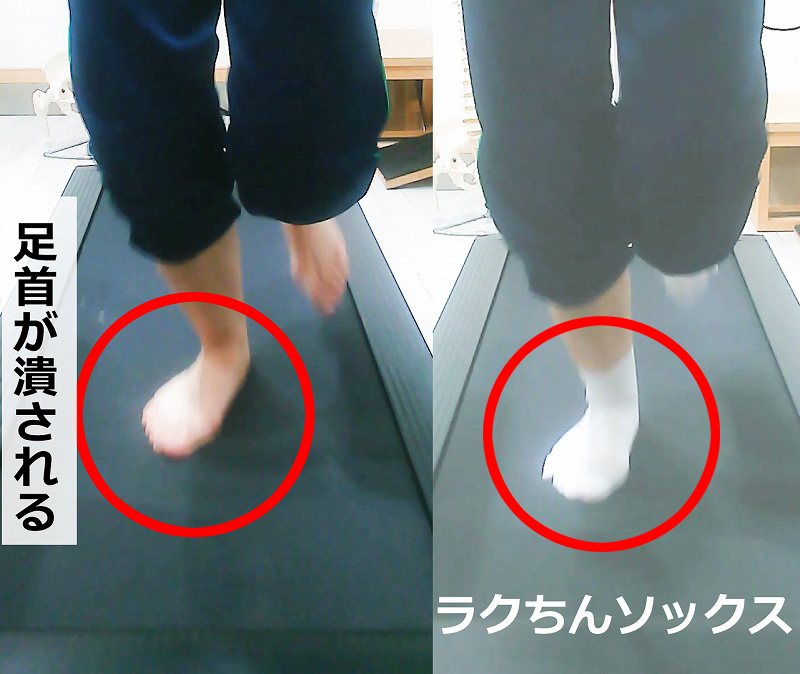 シンスプリントで膝の進行方向とつま先の向きがずれ、スネにねじれを伴う力が加わる仕組みを示した画像