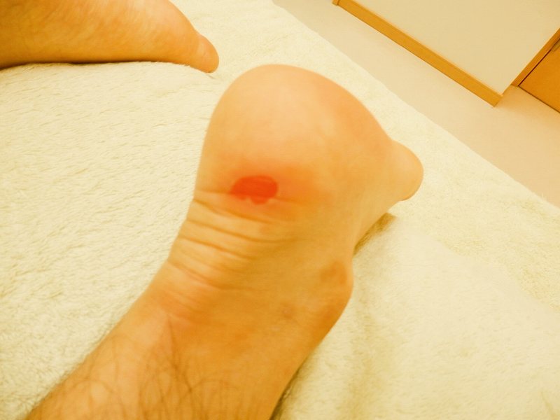 マメと靴擦れの違い|足トラブルを7つの原因から考える
