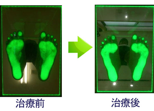 足のアーチが、お椀を伏せたような立体構造で身体へ加わる力を受け止める様子を示した画像
