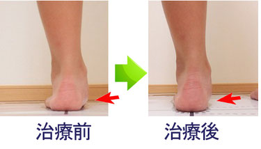 有痛性外脛骨