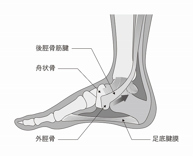 有痛性外脛骨