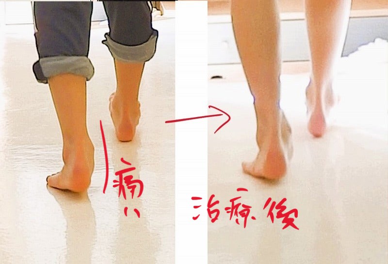 有痛性外脛骨 歩き方