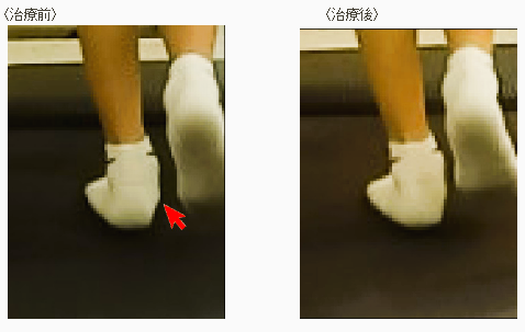 有痛性外脛骨
