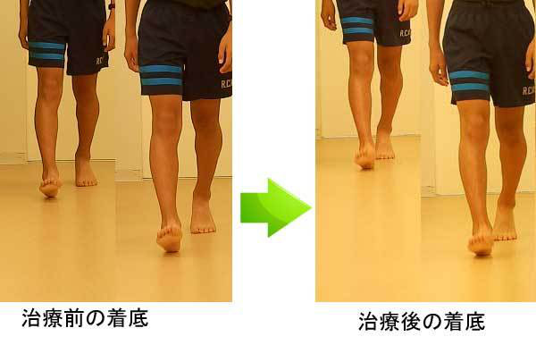 シーバー病の子どもの歩行を比較し、踵へ衝撃を集めている膝や足首の動きを改善する前後を示した画像