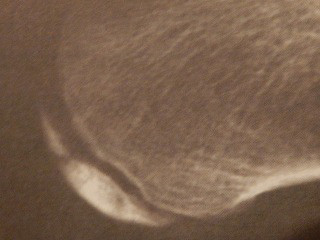踵骨骨端核の分節や硬化像が見られるレントゲン画像と、画像所見だけではシーバー病を判断できないことを示した画像