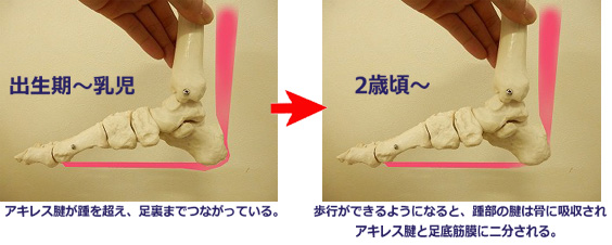 成長途中の踵骨にある踵骨骨端核と、アキレス腱が付着して牽引力を伝える位置を示したシーバー病の解説画像