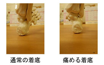 シーバー病が疑われる子どもの歩行を観察し、膝、踵の接地位置、体幹の傾きを確認している画像