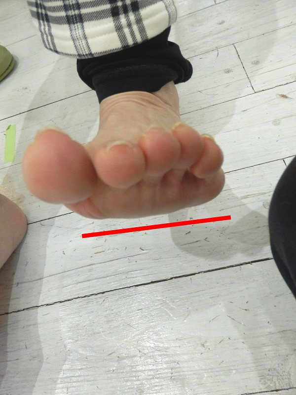 ウオノメで困っていない右足で、母指球から小指球まで平らな面ができている様子