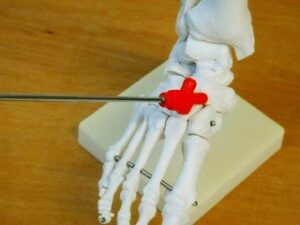 足の内側にある舟状骨の位置を示した足部骨格図。内くるぶしの前方、土踏まずの上に位置する骨を確認できます