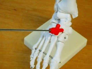 足の内側にある舟状骨の位置を示した足部骨格図。内くるぶしの前方、土踏まずの上に位置する骨を確認できます
