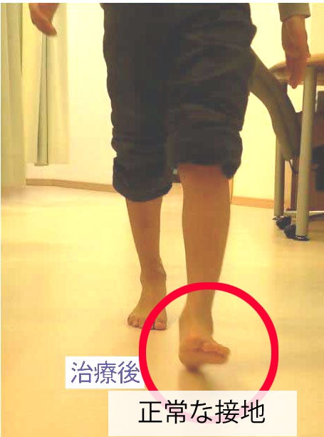 反対側の足の蹴り出しを整える前後で、身体の横への傾きと、痛む側の踵が地面へ着く位置を比較した歩行画像