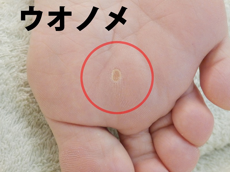 前足部の尖った部分へ体重が集中し、ウオノメやタコができやすくなる場所を示した画像