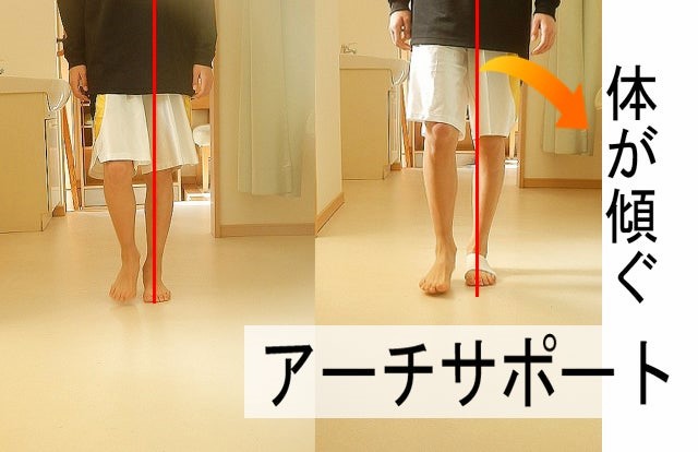 アーチサポートの使用前後で歩行中の身体の傾きを比較し外側への移動を示した画像