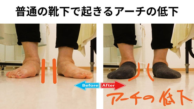 靴下を履いて立ったときに、足部アーチが低下し、足首が内側へ移動した状態