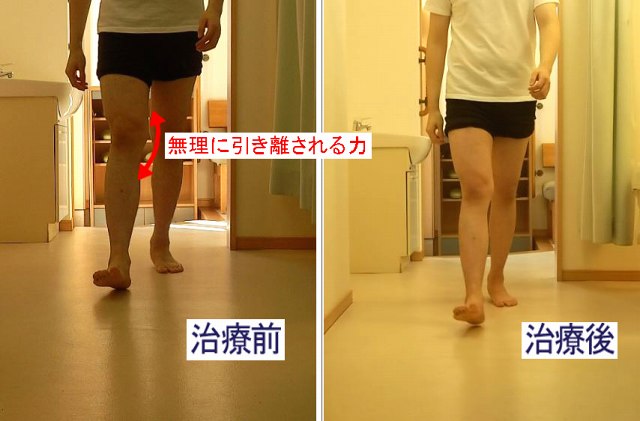 歩行やランニングの遊脚期に、空中へ浮いた脚が前後方向だけでなく膝下でねじれる動きを示した画像