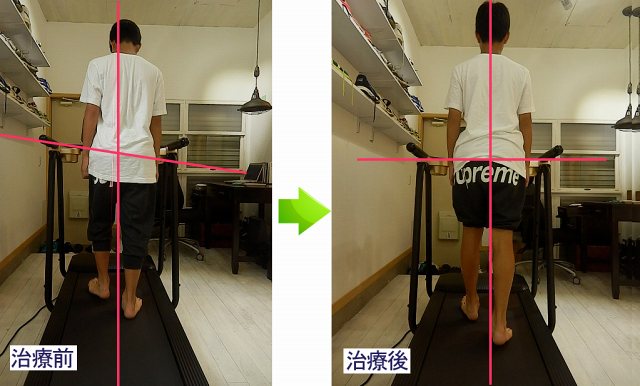 初期接地を後方から確認し、体幹の中心線がほぼ垂直で、骨盤が水平に近い状態を示した画像