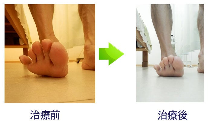 足裏のウオノメやマメを確認するときに、左右の小指、前足部、踵、足首を比較する方法