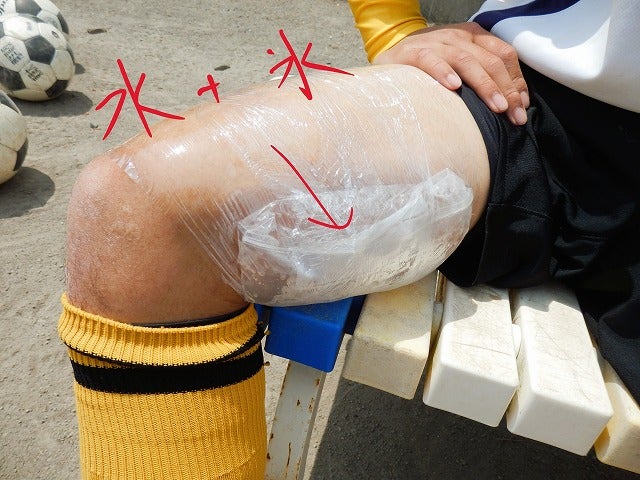 氷水を入れた袋を患部へ当て、ずれない程度に軽く固定した様子