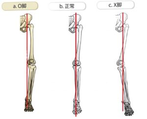 ミクリッツ線(Mikulicz Line)とは? キャプチャ