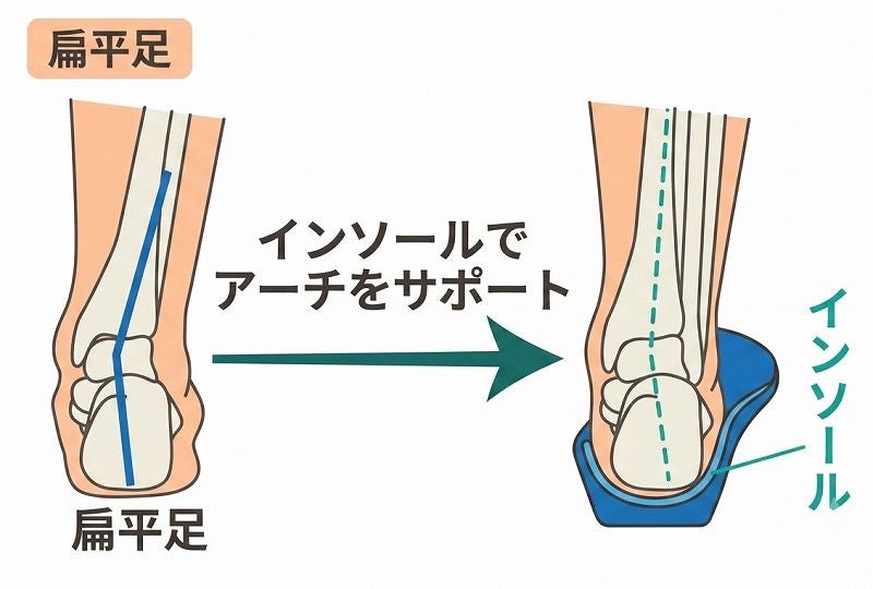 内側アーチサポートで土踏まずを持ち上げたときに確認する身体の荷重位置を示した説明画像