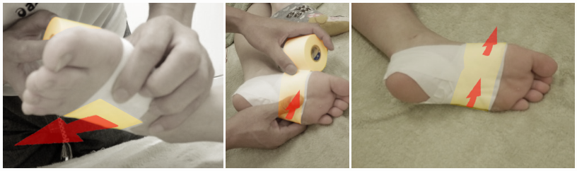足底腱膜炎のテーピングを貼り終えた足裏と足の甲の状態を示した完成写真
