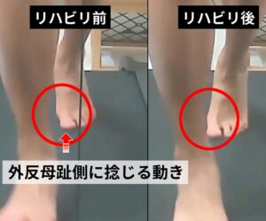 外反母趾のリハビリテーション│小指とかかとの動きを整える方法 14