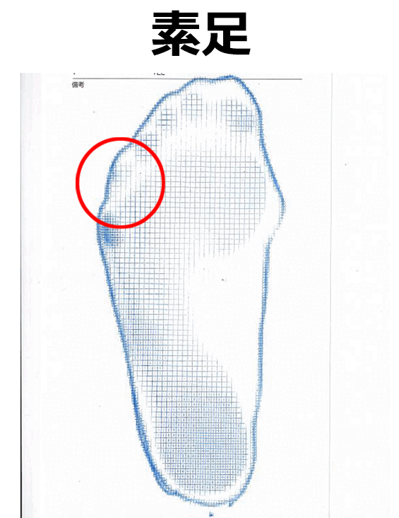 素足と一般的な靴下を着用したときのフットプリントと小指の位置の比較