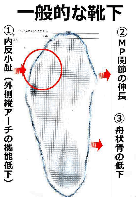 小指の動きを妨げない条件で足裏のアーチと骨の連結が変化する比較