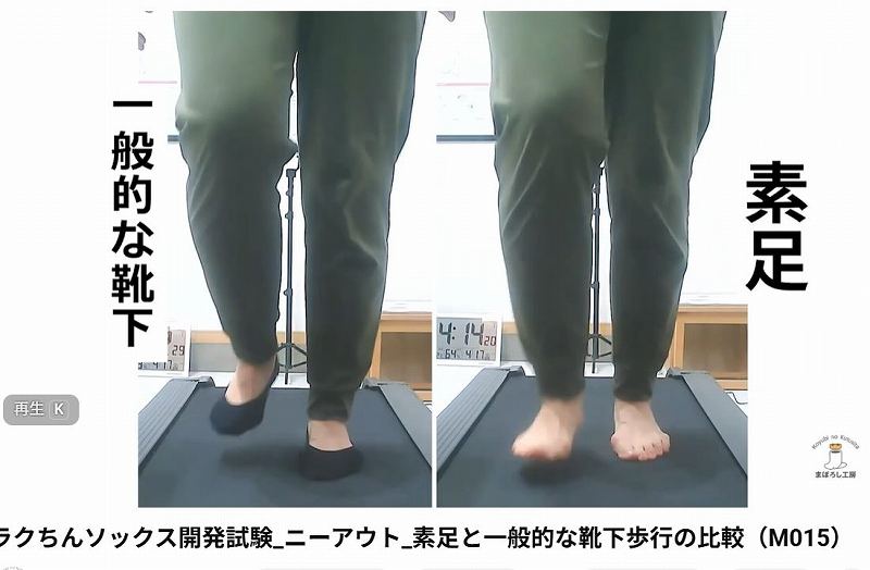 一般的な靴下を履いて歩いたときに足首の外反とアーチの倒れ込みが増えた状態