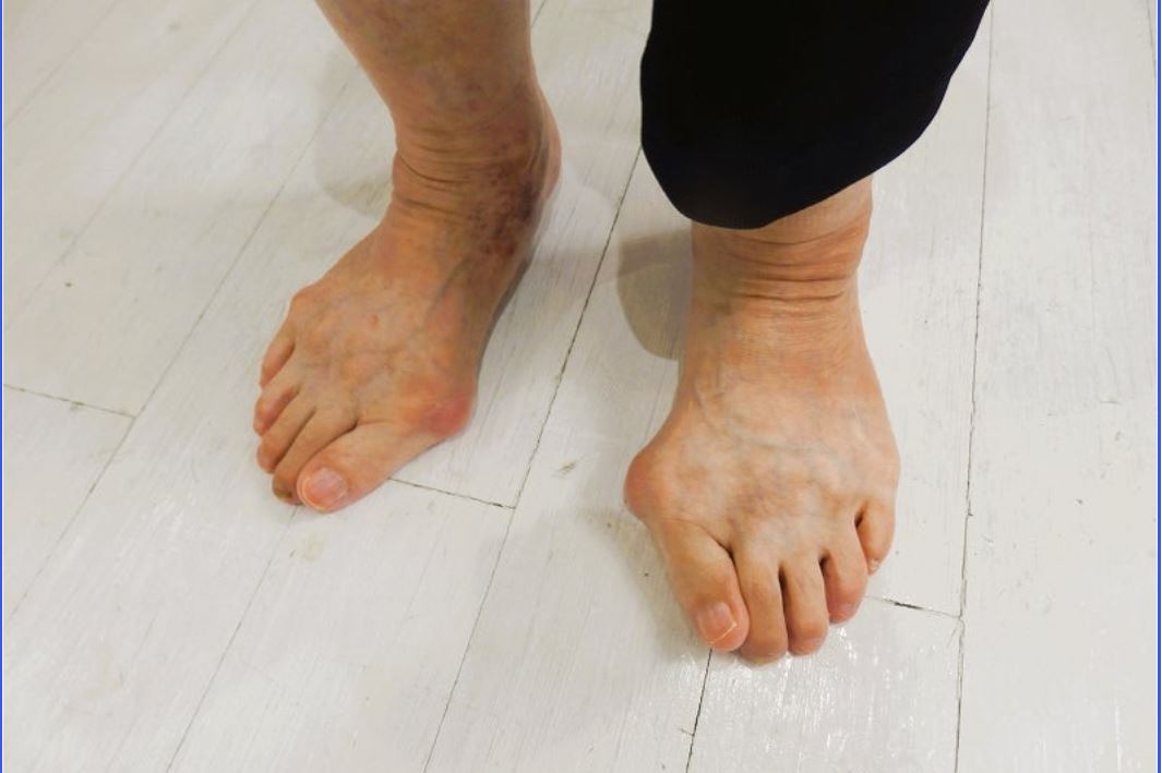 外反母趾は、どこから始まるのか