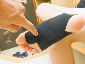足底腱膜炎で足裏への負担を調整する目的でテーピングを施した足の例