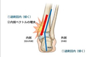 後脛骨筋炎　イラスト