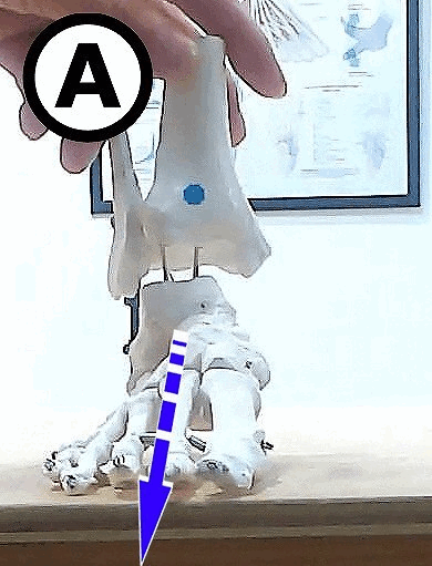 足のアーチが低下するとつま先が外側を向く様子
