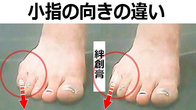 内反小趾の小指を絆創膏で一周巻き、小指の動きを制限した状態